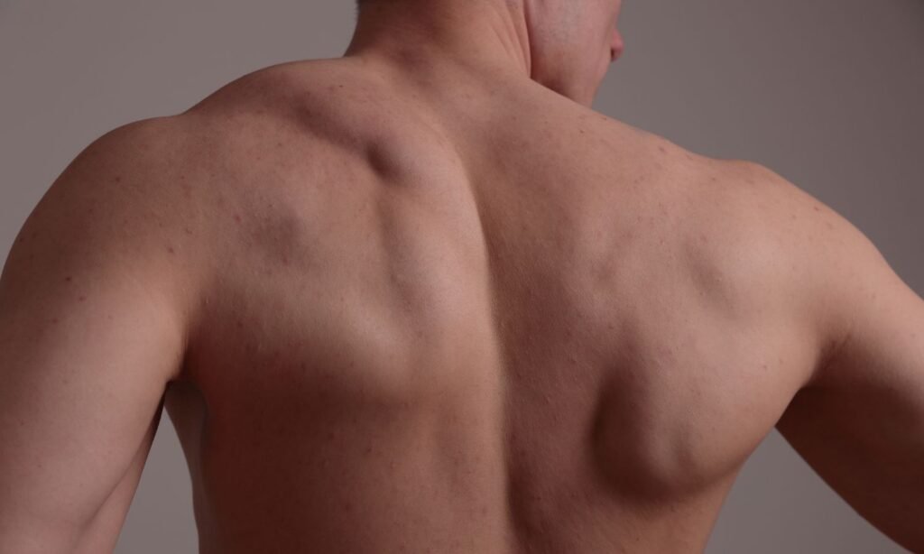 gym goer assessing back acne